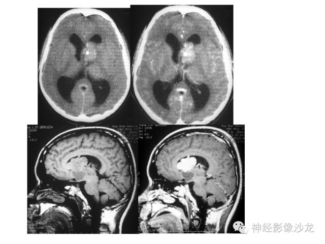 【病例】颅内神经元错构瘤1例CT及MR影像表现