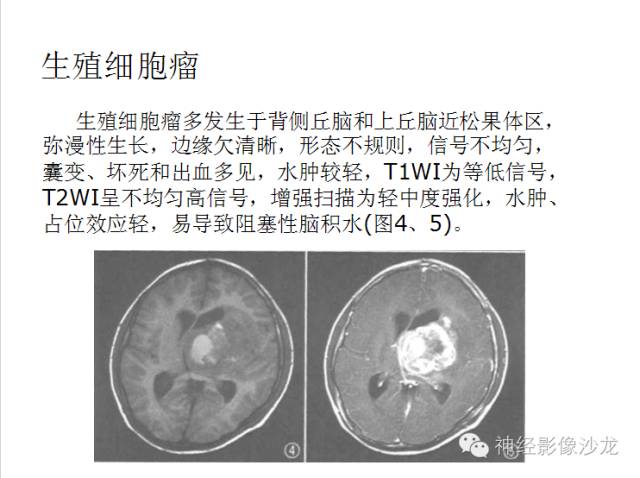 【病例】颅内神经元错构瘤1例CT及MR影像表现