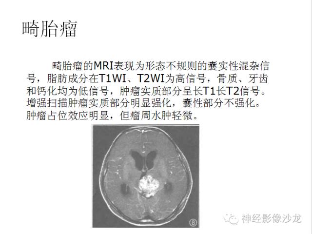 【病例】颅内神经元错构瘤1例CT及MR影像表现