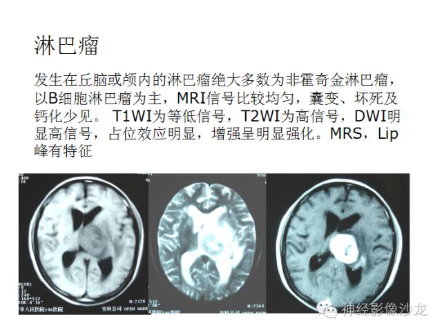 【病例】颅内神经元错构瘤1例CT及MR影像表现