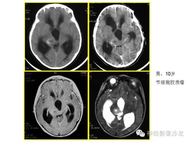 【病例】颅内神经元错构瘤1例CT及MR影像表现