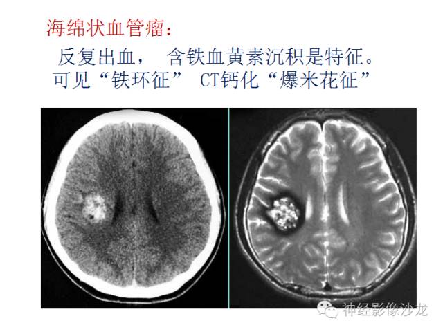 【病例】颅内神经元错构瘤1例CT及MR影像表现