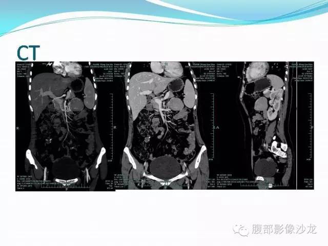 【病例】腹腔Castleman病1例CT影像表现 【病例】腹腔Castleman病1例CT影像表现