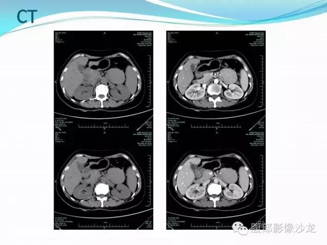 【病例】腹腔Castleman病1例CT影像表现 【病例】腹腔Castleman病1例CT影像表现