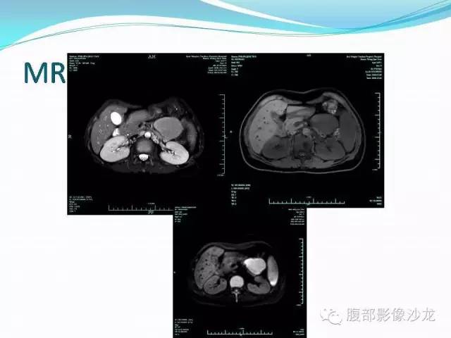 【病例】腹腔Castleman病1例CT影像表现 【病例】腹腔Castleman病1例CT影像表现