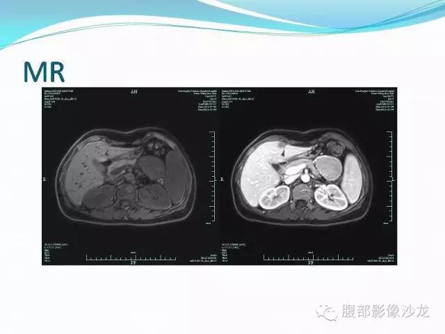 【病例】腹腔Castleman病1例CT影像表现 【病例】腹腔Castleman病1例CT影像表现
