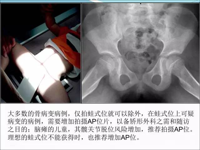 【PPT】儿童髋关节病变的影像学表现
