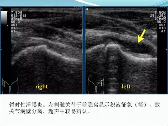【PPT】儿童髋关节病变的影像学表现