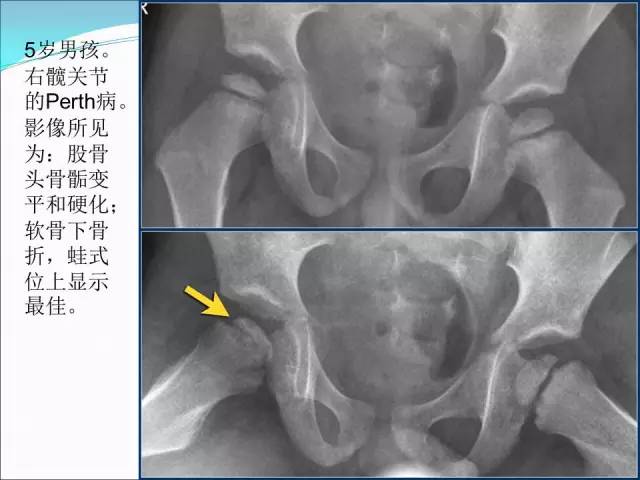 【PPT】儿童髋关节病变的影像学表现