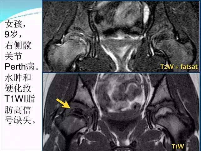 【PPT】儿童髋关节病变的影像学表现