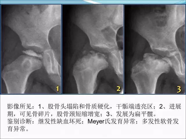 【PPT】儿童髋关节病变的影像学表现