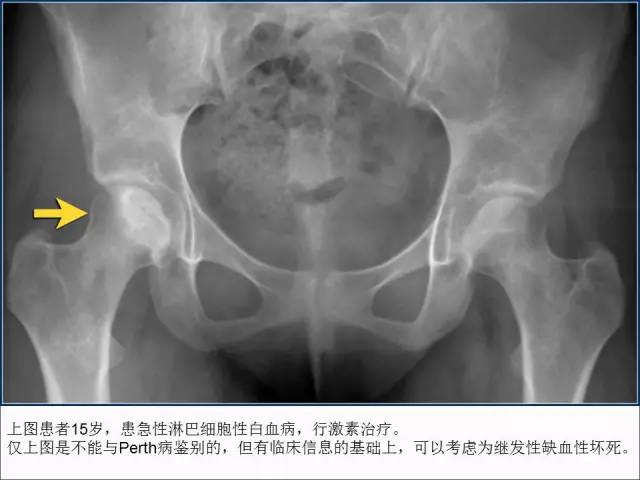 【PPT】儿童髋关节病变的影像学表现
