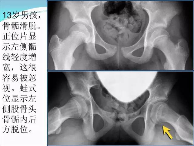 【PPT】儿童髋关节病变的影像学表现