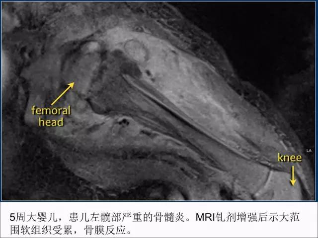 【PPT】儿童髋关节病变的影像学表现