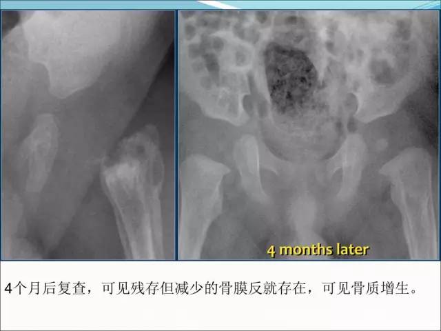 【PPT】儿童髋关节病变的影像学表现