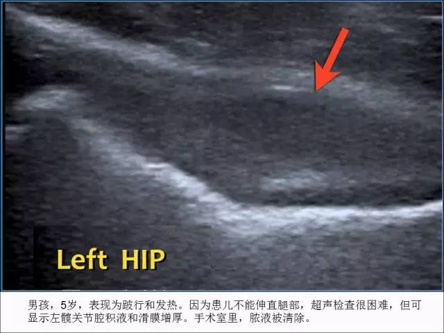【PPT】儿童髋关节病变的影像学表现