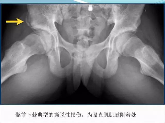 【PPT】儿童髋关节病变的影像学表现