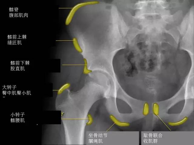 【PPT】儿童髋关节病变的影像学表现