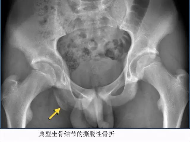 【PPT】儿童髋关节病变的影像学表现