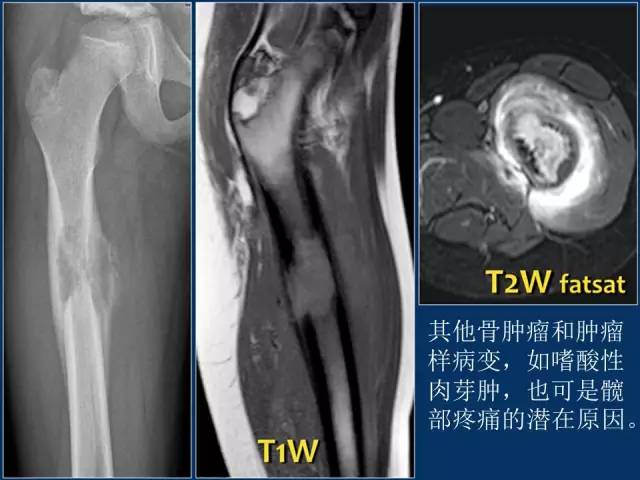 【PPT】儿童髋关节病变的影像学表现