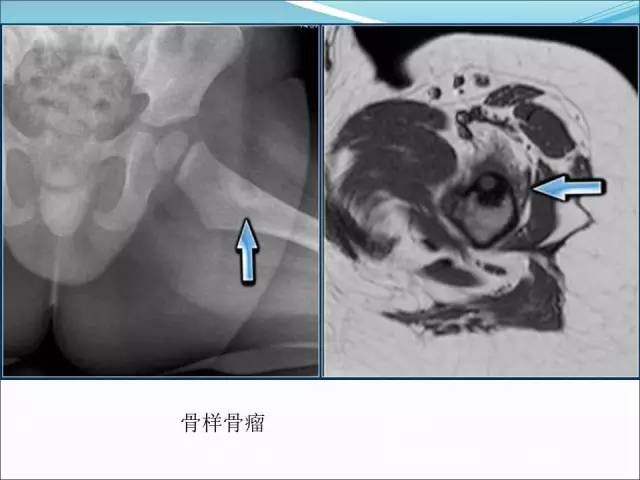 【PPT】儿童髋关节病变的影像学表现