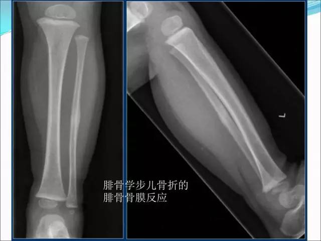 【PPT】儿童髋关节病变的影像学表现