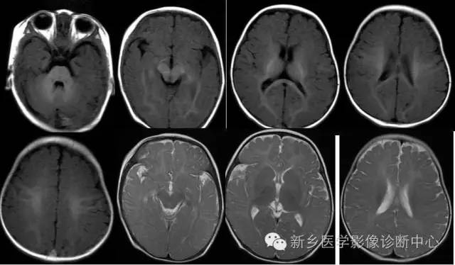 再次认识髓鞘的形成和MRI表现 再次认识髓鞘的形成和MRI表现