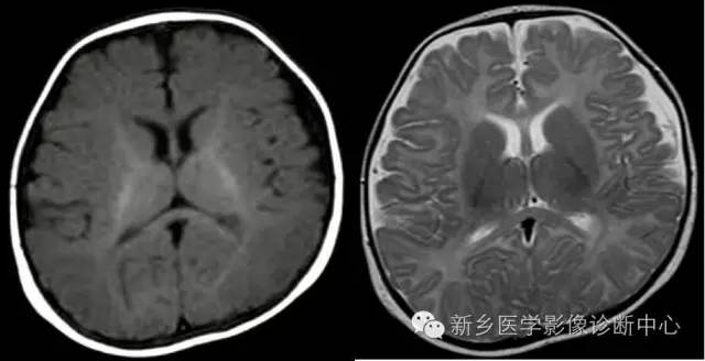 再次认识髓鞘的形成和MRI表现