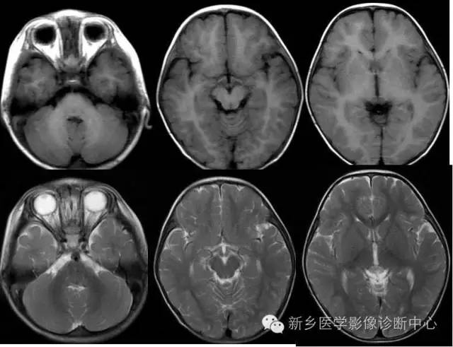 再次认识髓鞘的形成和MRI表现 再次认识髓鞘的形成和MRI表现