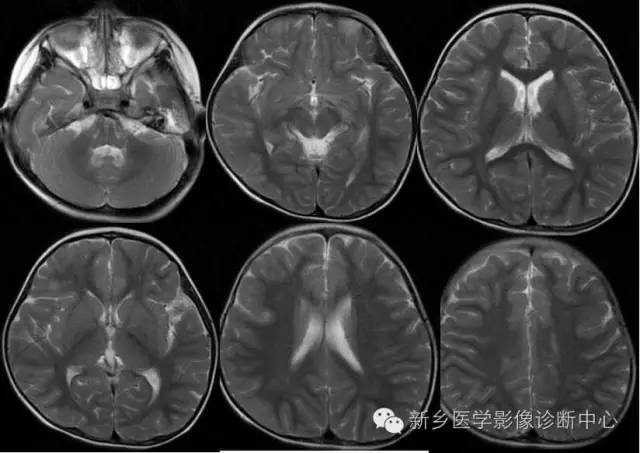 再次认识髓鞘的形成和MRI表现 再次认识髓鞘的形成和MRI表现