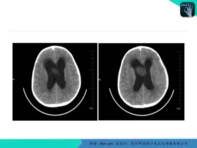 【病例】毛细胞粘液样型星形细胞瘤1例CT及MR影像表现