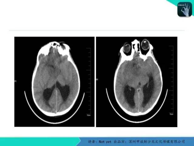 【病例】毛细胞粘液样型星形细胞瘤1例CT及MR影像表现
