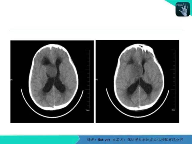 【病例】毛细胞粘液样型星形细胞瘤1例CT及MR影像表现