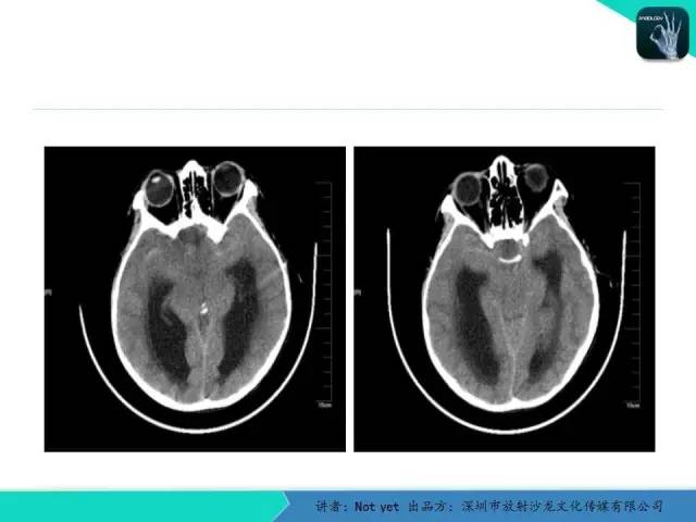 【病例】毛细胞粘液样型星形细胞瘤1例CT及MR影像表现