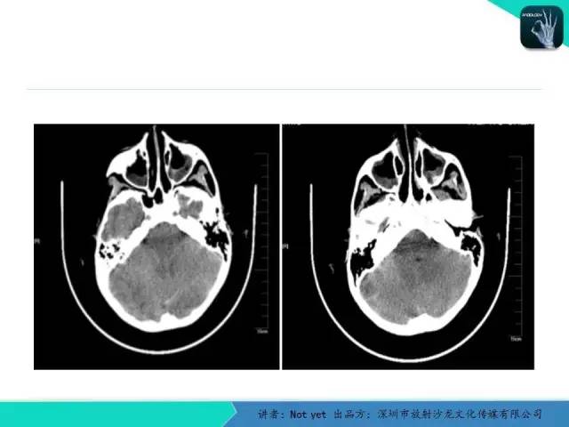 【病例】毛细胞粘液样型星形细胞瘤1例CT及MR影像表现