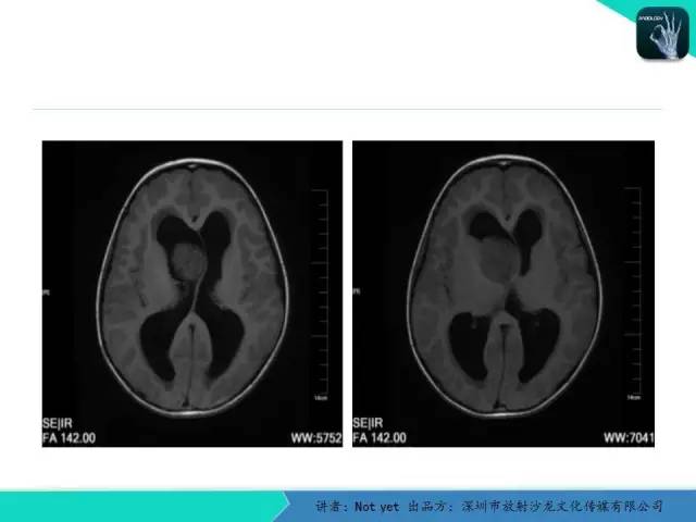 【病例】毛细胞粘液样型星形细胞瘤1例CT及MR影像表现