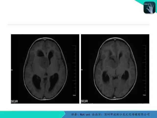 【病例】毛细胞粘液样型星形细胞瘤1例CT及MR影像表现