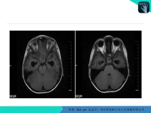 【病例】毛细胞粘液样型星形细胞瘤1例CT及MR影像表现