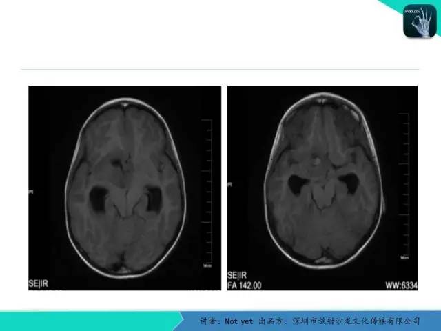 【病例】毛细胞粘液样型星形细胞瘤1例CT及MR影像表现
