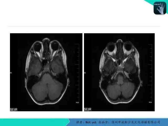 【病例】毛细胞粘液样型星形细胞瘤1例CT及MR影像表现