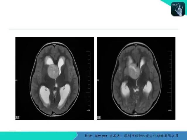 【病例】毛细胞粘液样型星形细胞瘤1例CT及MR影像表现