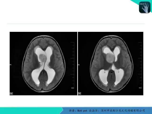 【病例】毛细胞粘液样型星形细胞瘤1例CT及MR影像表现
