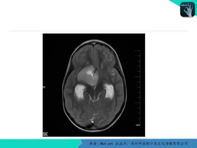 【病例】毛细胞粘液样型星形细胞瘤1例CT及MR影像表现