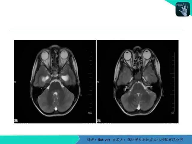 【病例】毛细胞粘液样型星形细胞瘤1例CT及MR影像表现