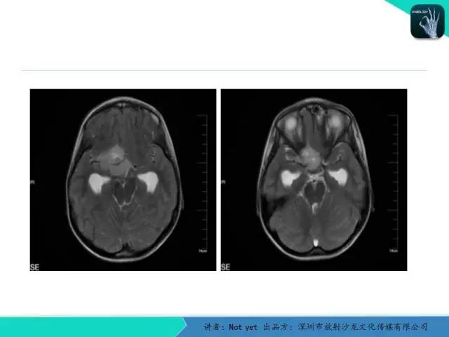 【病例】毛细胞粘液样型星形细胞瘤1例CT及MR影像表现