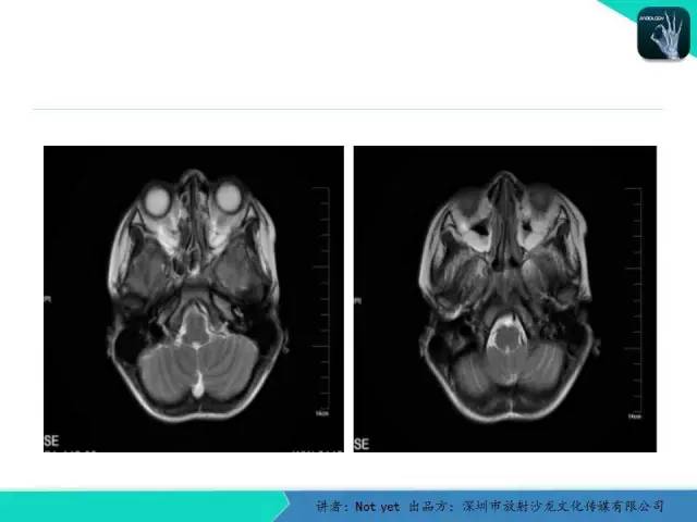 【病例】毛细胞粘液样型星形细胞瘤1例CT及MR影像表现