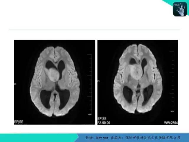 【病例】毛细胞粘液样型星形细胞瘤1例CT及MR影像表现