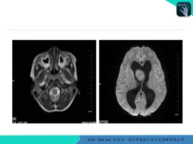 【病例】毛细胞粘液样型星形细胞瘤1例CT及MR影像表现
