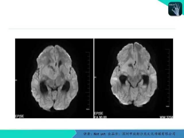 【病例】毛细胞粘液样型星形细胞瘤1例CT及MR影像表现