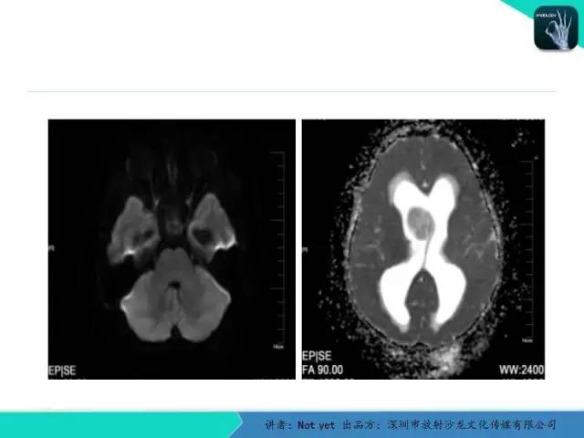 【病例】毛细胞粘液样型星形细胞瘤1例CT及MR影像表现